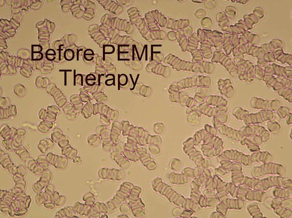 PEMF Blood Analysis PEMF Blood Analysis