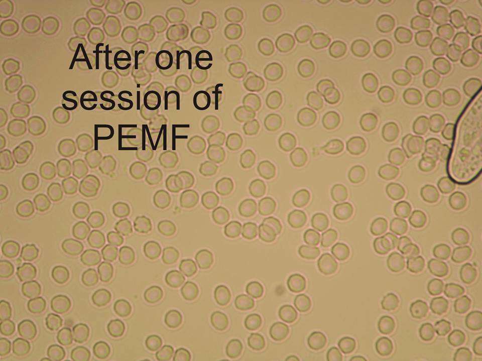 PEMF Blood Analysis PEMF Blood Analysis
