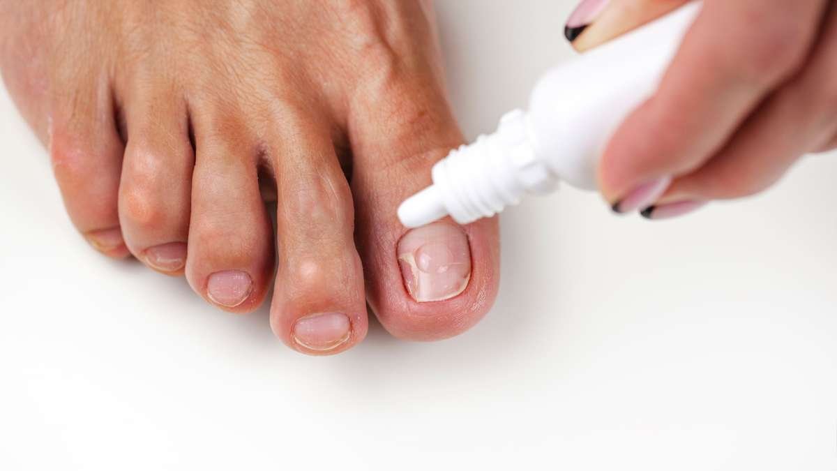 benefits of tea tree oil for nail fungus