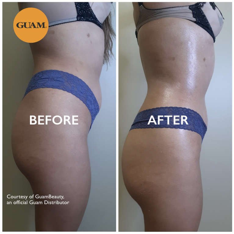 Guam cellulite wraps before and after 