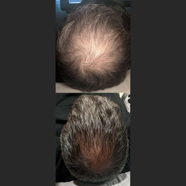 Before After RevivHair Max
