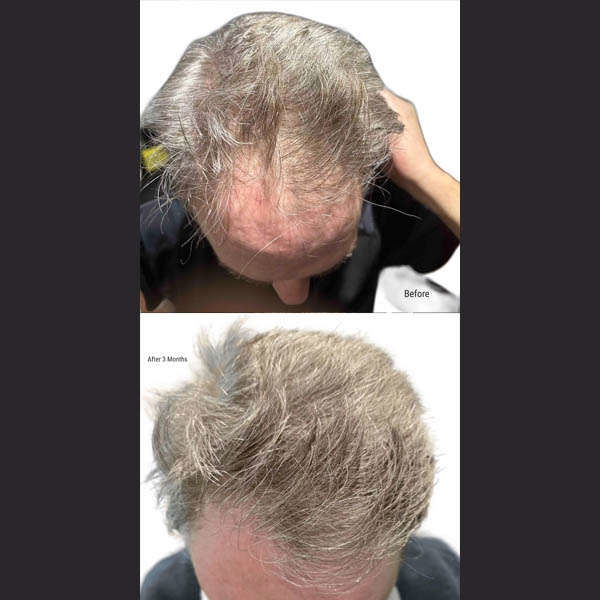Before After RevivHair Max
